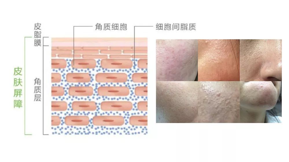 痘印红血丝修复护肤品平价,痘印泛红团购