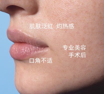 痘印红血丝修复护肤品平价,痘印泛红团购