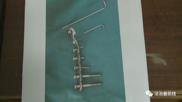 骨折手术后两个月去取钢钉,女子骨折2个月