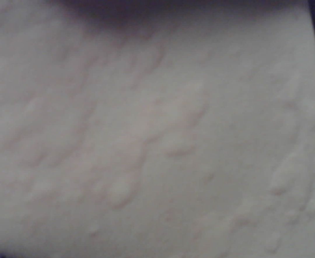 中医治疗荨麻疹一定要透疹,荨麻疹止痒大揭秘