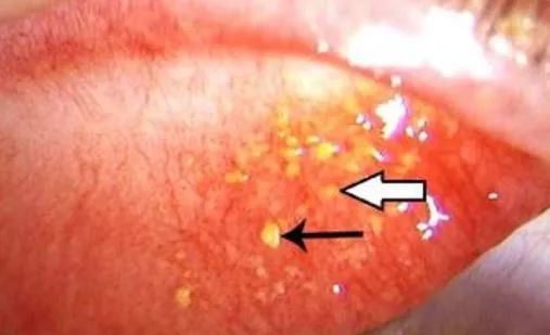 医生从28岁男子体内取出485块石头,医生从病人眼中取出十多个美瞳