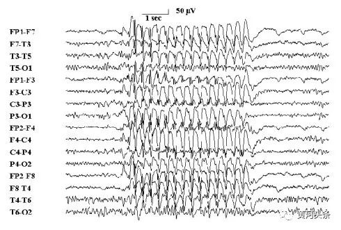 癫痫大脑异常放电会导致头痛吗,癫痫患者脑部异常放电有意识