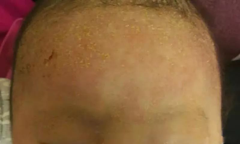夏季宝宝湿疹高发新手妈妈看过来,婴儿特殊类型的湿疹以及皮炎