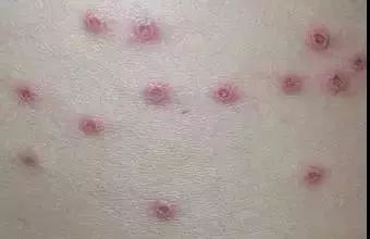 夏季宝宝湿疹高发新手妈妈看过来,婴儿特殊类型的湿疹以及皮炎