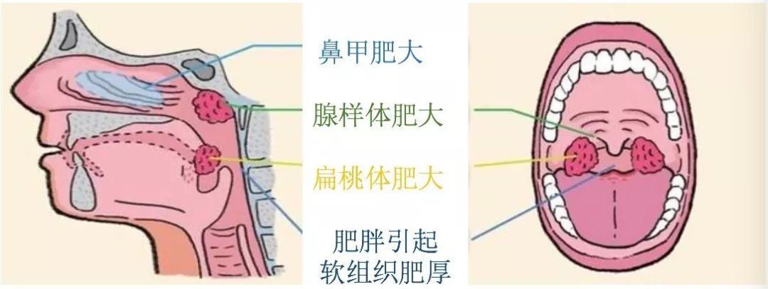 儿童呼噜症最佳睡眠方法,世界睡眠日科普类短视频英文版