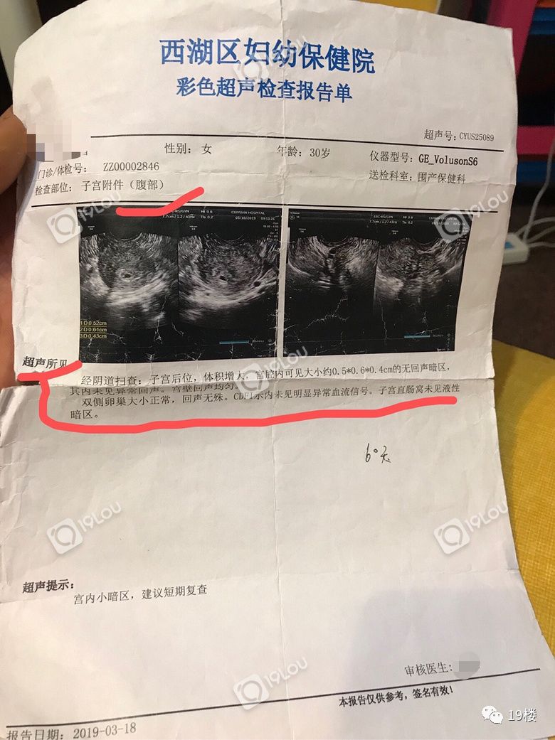 做阴超流产了,做完阴超自然流产