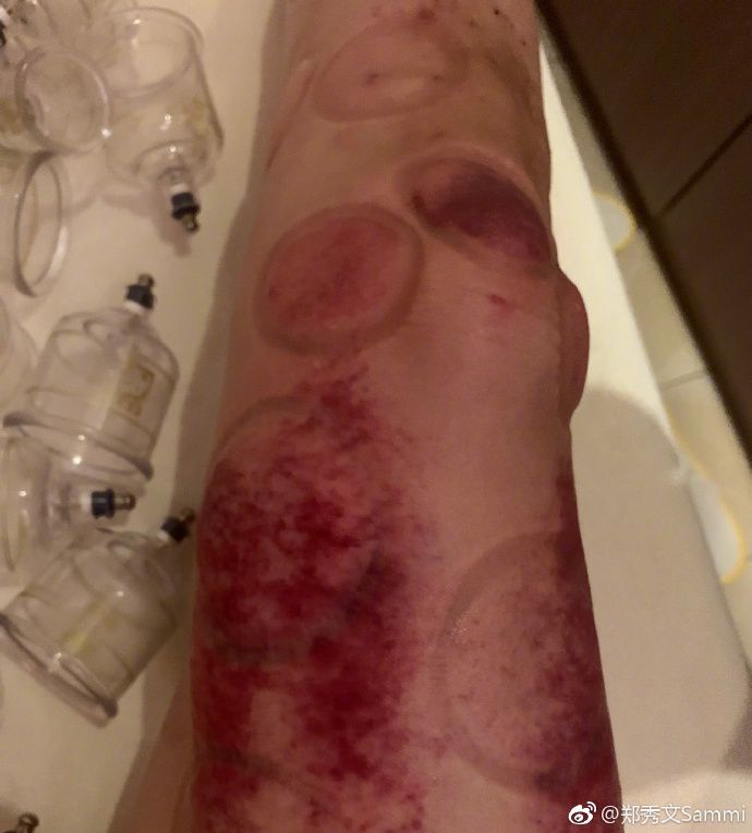 郑秀文腿伤,47岁郑秀文曝身体现状