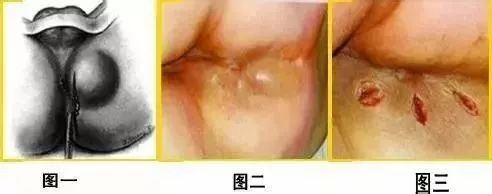 中医都有哪些药治疗肛周脓肿的,倪海厦讲中药治肛周脓肿