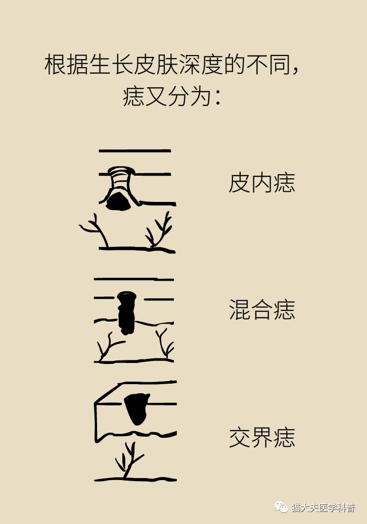 什么症状表明痣已经在恶变,先天性黑素细胞痣恶变的概率大吗