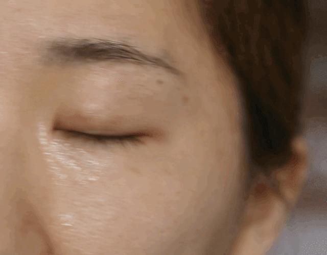 埋线双眼皮分叉修护动作,双眼皮埋线术后注意事项大全