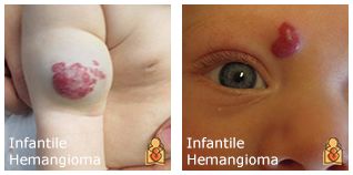 宝宝身上有这六种胎记,宝宝身上这8种胎记需要密切关注