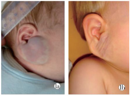 宝宝身上有这六种胎记,宝宝身上这8种胎记需要密切关注