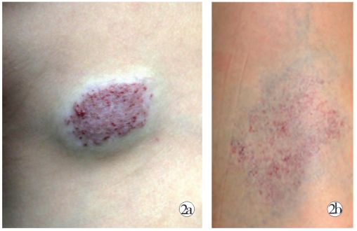 宝宝身上有这六种胎记,宝宝身上这8种胎记需要密切关注