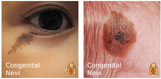 宝宝身上有这六种胎记,宝宝身上这8种胎记需要密切关注