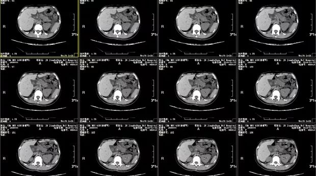 又遇疑难腹水案，且看元芳如何破！
