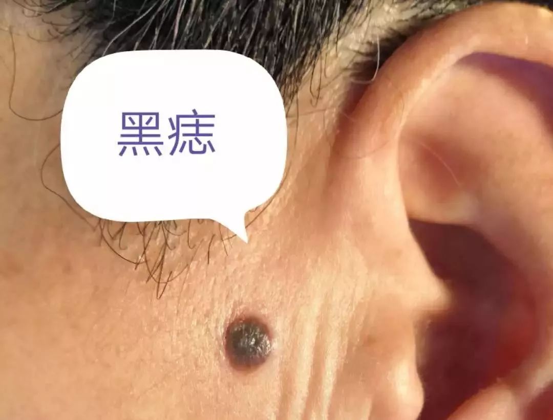 小小黑痣该不该治?该如何治?