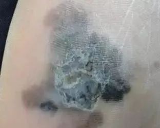 小小黑痣该不该治?该如何治?