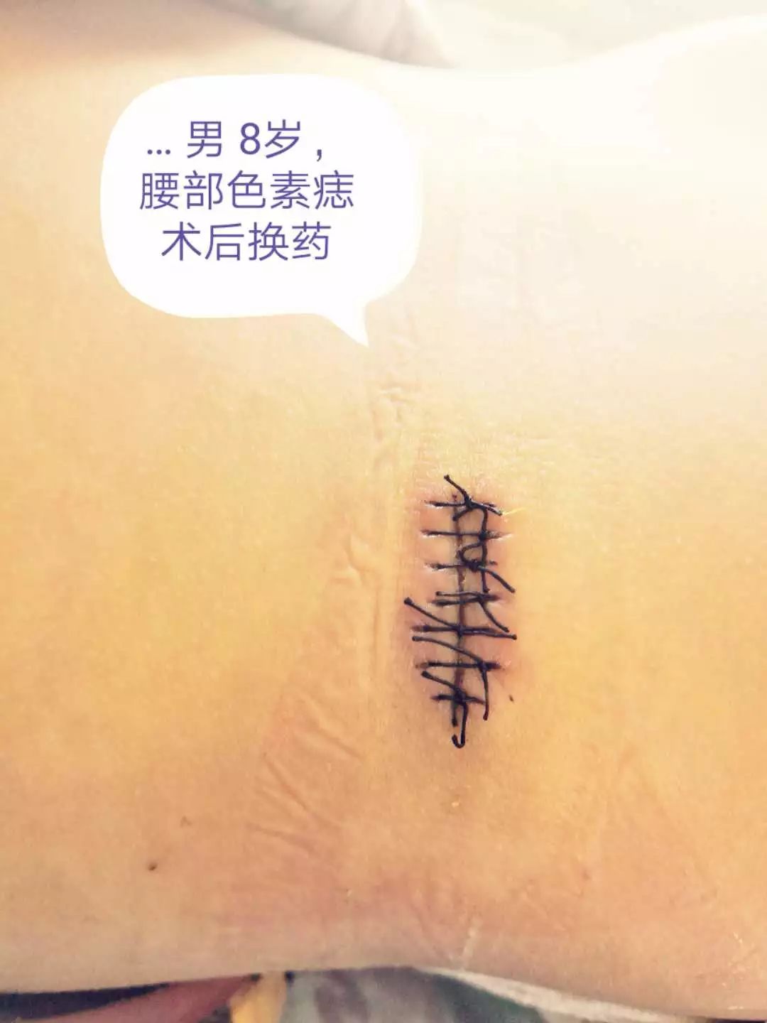 小小黑痣该不该治?该如何治?