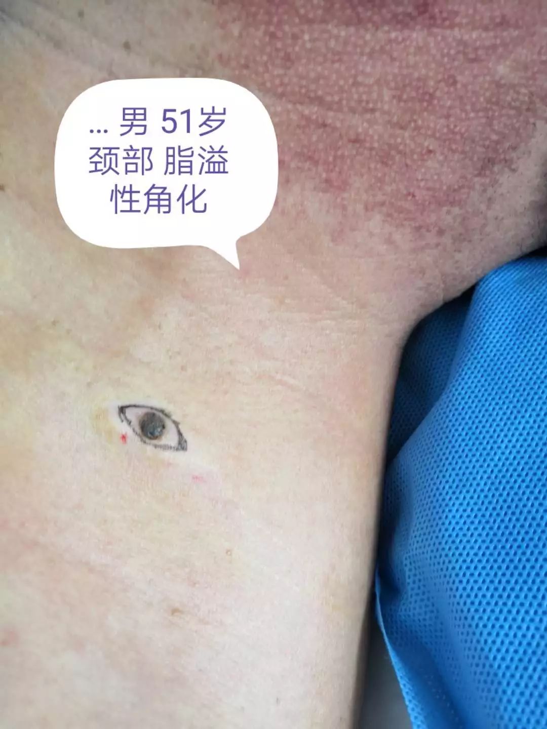 小小黑痣该不该治？该如何治？