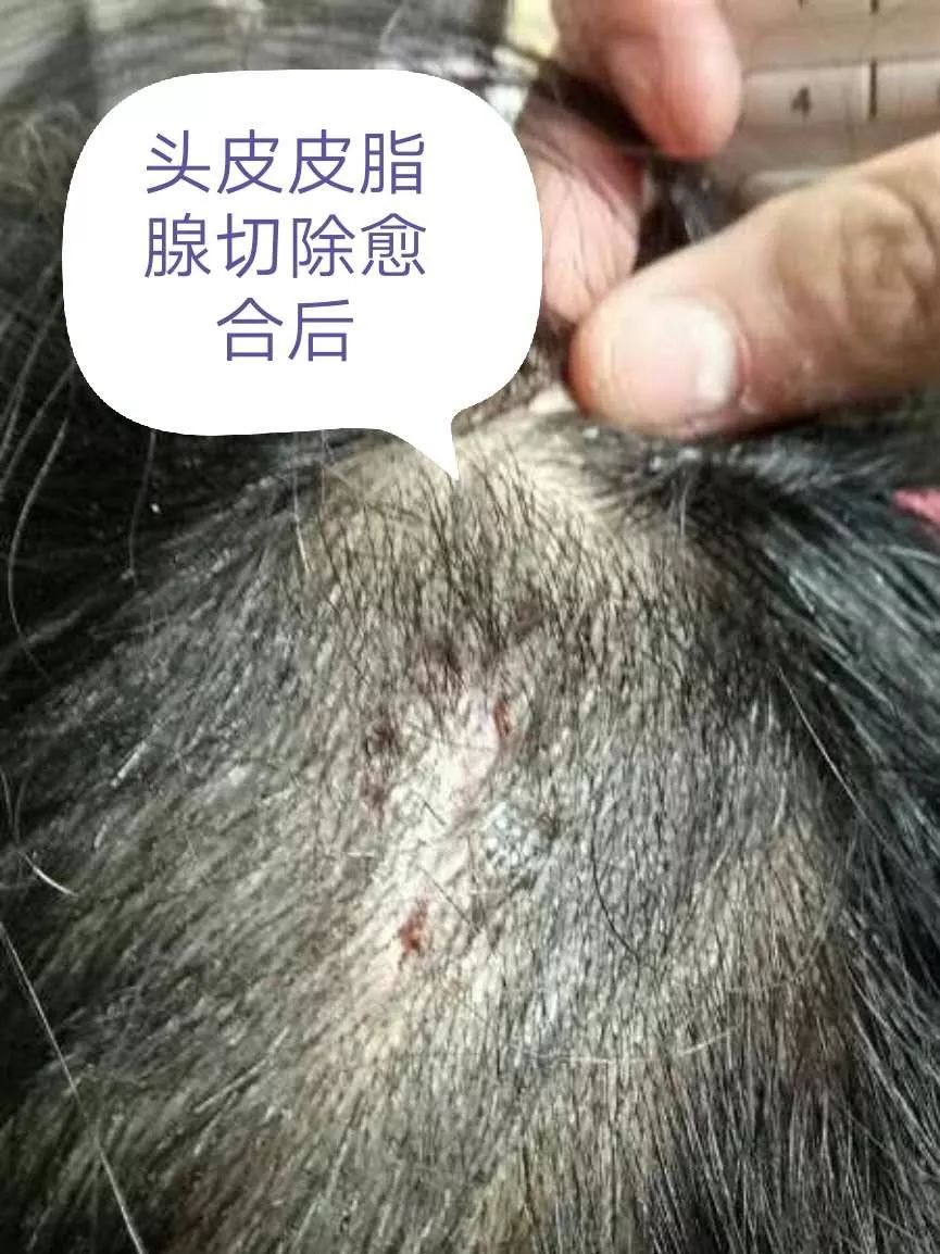小小黑痣该不该治?该如何治?