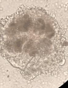 4岁娃肚大如孕妇，竟从体内抽出2斤寄生虫液！