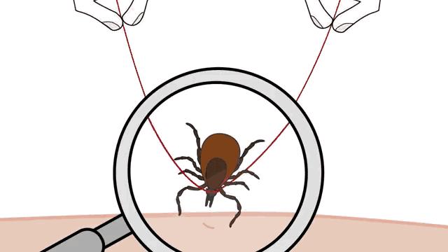 成人肚脐眼凸起肉球,肚脐眼隆起的肉球