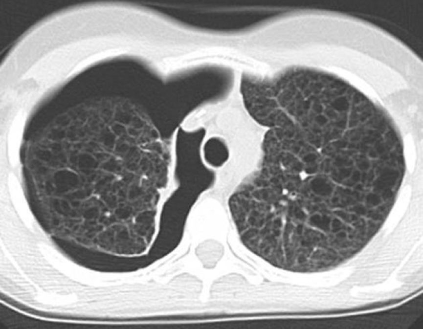 双肺上叶胸膜下见薄壁空腔正常吗,双肺多发类圆形薄壁透亮影严重吗