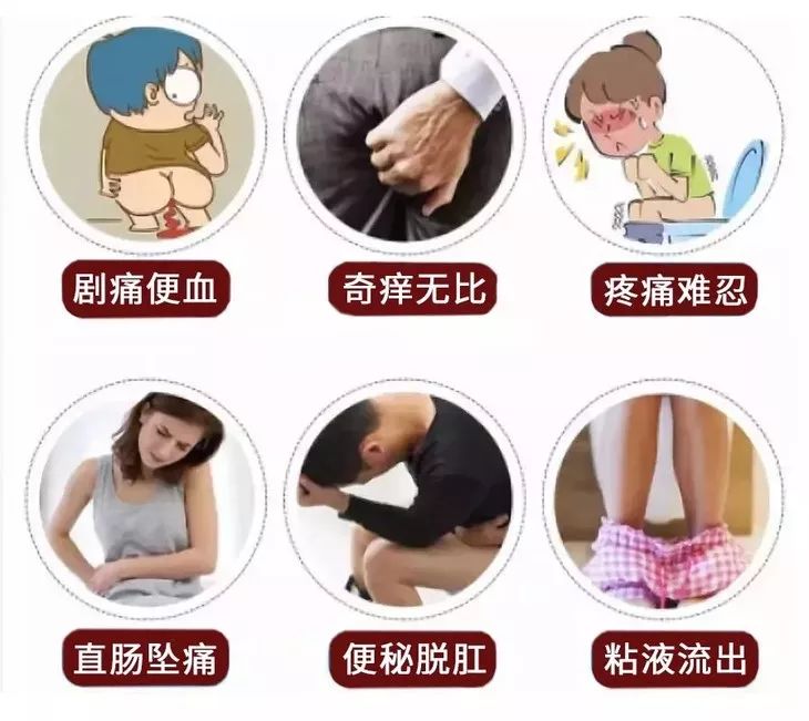 80%的痔疮无需手术治疗吗,痔疮又犯了用这个方法轻松治痔疮
