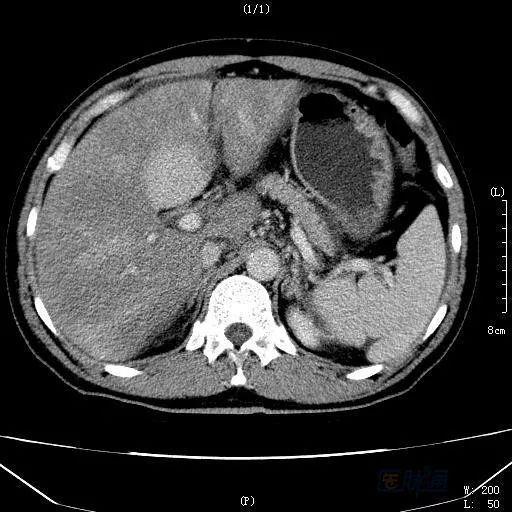 身边有肝癌治好的吗,治好肝癌全国首例
