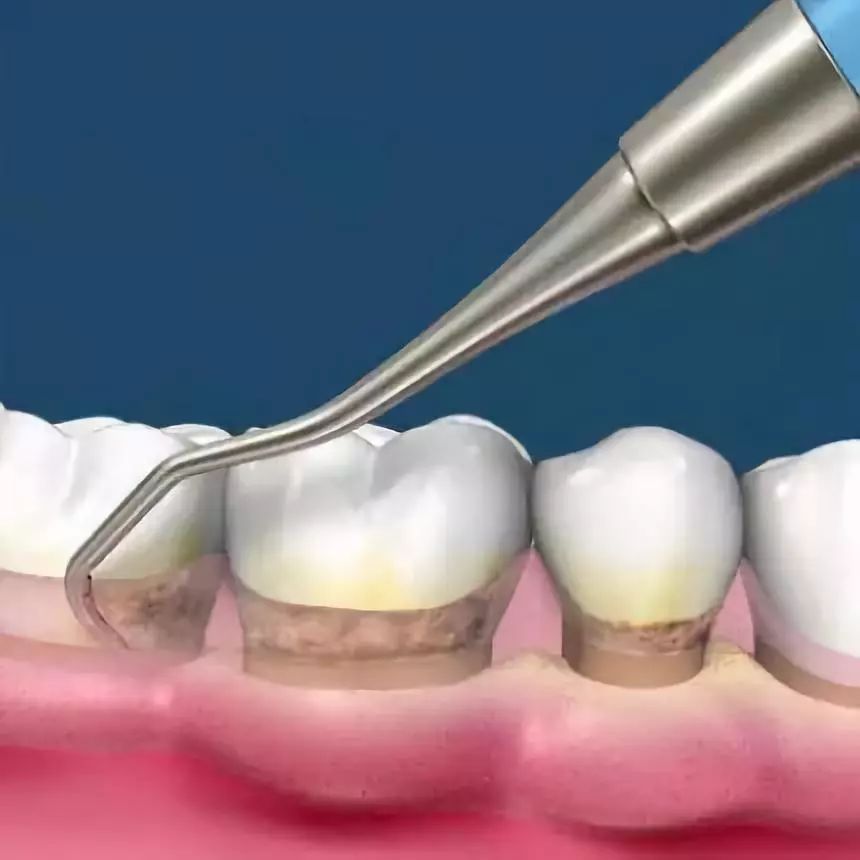 不到1折疯抢！全家口腔健康有保证~29.9元抢购原价895元劲松牙科家庭口腔护理套餐！超声波洁牙+中老年口腔护理+儿童口腔护理…