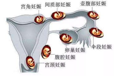 hcg值能判断是宫内还是宫外孕吗,孕5周hcg多少可以排除宫外孕