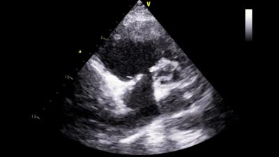 先天性心脏畸形如何治疗,常见先天性心脏畸形的外科治疗