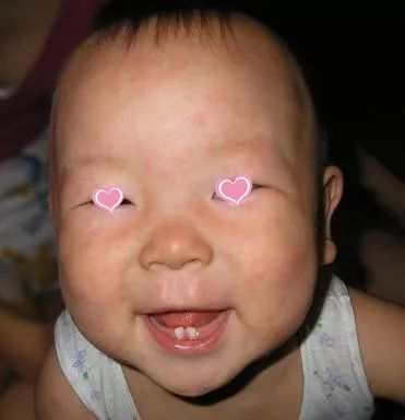 儿童常见皮疹及处理方法,儿童春季高发皮肤病