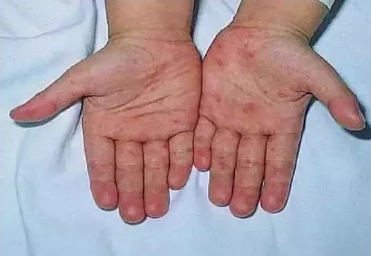 儿童常见皮疹及处理方法,儿童春季高发皮肤病