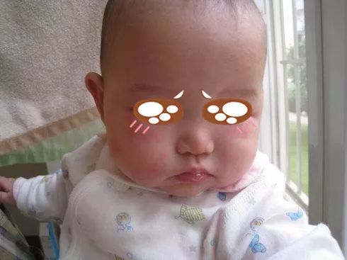 儿童常见皮疹及处理方法,儿童春季高发皮肤病