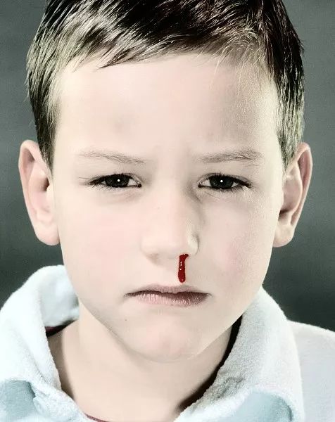 孩子流鼻血了怎么办最有效,小孩流鼻血怎么办快速解决方法