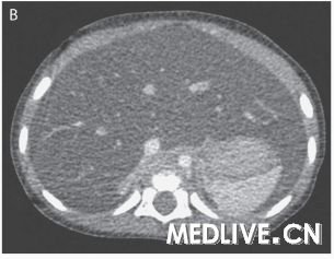 急性肝功能衰竭死亡病例,急性肝功能衰竭能彻底治好吗