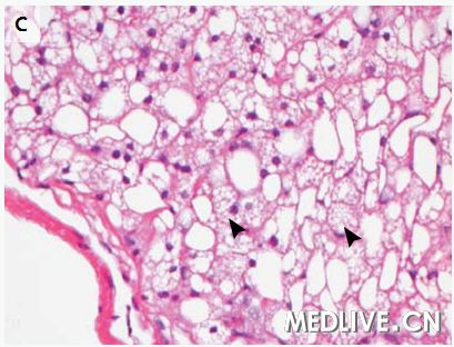 急性肝功能衰竭死亡病例,急性肝功能衰竭能彻底治好吗