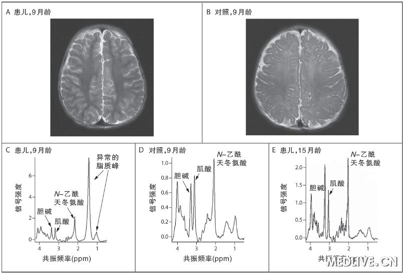 急性肝功能衰竭死亡病例,急性肝功能衰竭能彻底治好吗