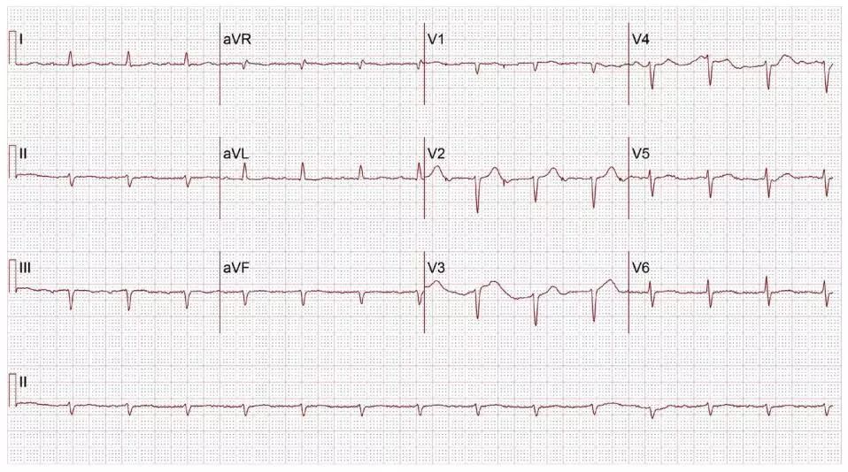 心电图提前出现宽大的qrs波,宽口qrs波心动过速的鉴别诊断