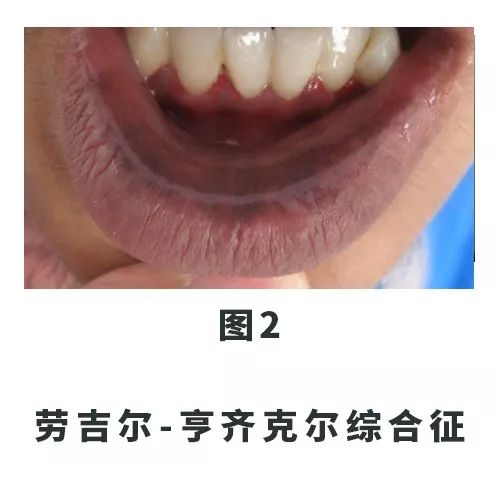 口腔里和嘴唇长满了黑点,口唇上的黑斑要引起重视