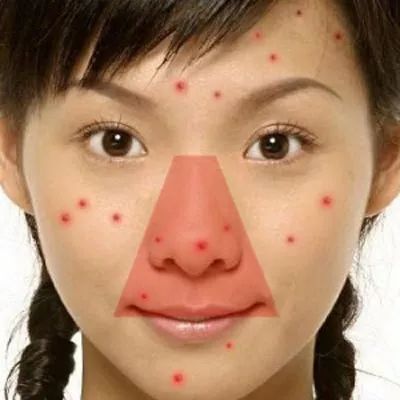 这个地方长痘千万别动!这起悲剧为所有人敲响警钟!