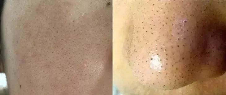 拨黑头工具草莓鼻,去黑头神器真的能吸出黑头