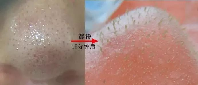 拨黑头工具草莓鼻,去黑头神器真的能吸出黑头
