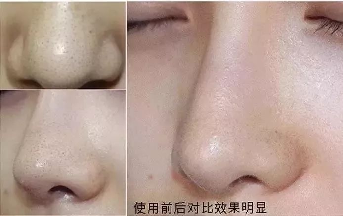 拨黑头工具草莓鼻,去黑头神器真的能吸出黑头