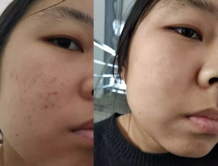 拨黑头工具草莓鼻,去黑头神器真的能吸出黑头