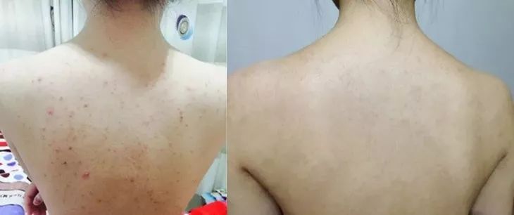 拨黑头工具草莓鼻,去黑头神器真的能吸出黑头