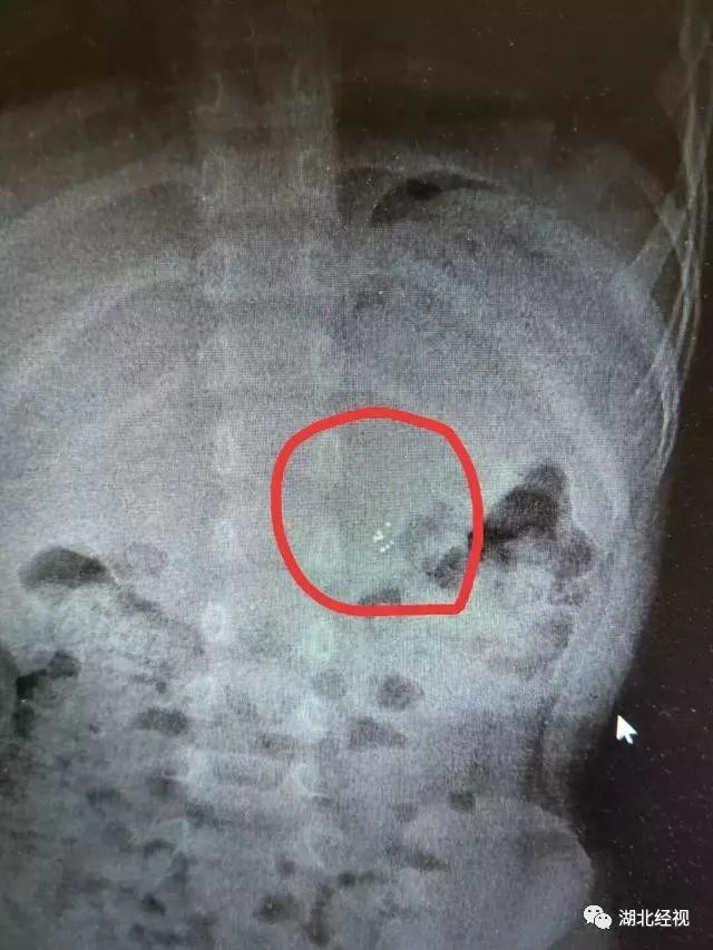 3岁宝宝误食体温计水银怎么办,孩子咬体温计误食水银催吐了