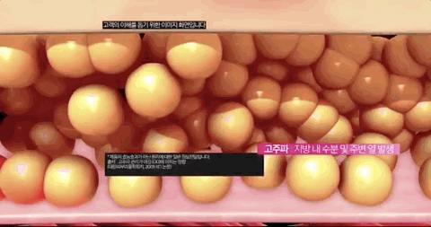 无需抽脂的韩国溶脂仪，2周抚平橘皮，腰围还瘦3cm