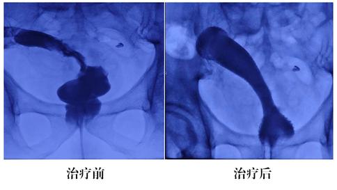 鐑熷彴鍖婚櫌鍋氳偁姊楅樆浠烽挶,鑲犳闃绘花宸炲尰瀛﹂櫌
